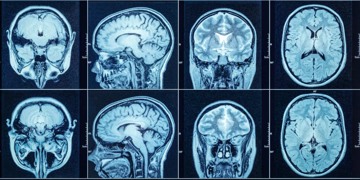 Multiple brain scan images from an MRI after a car accident used to evaluate traumatic injury and internal damage